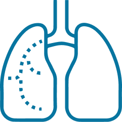 La pneumonie à pneumocoques