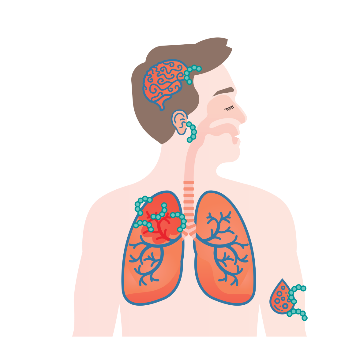 Wat is een pneumokokkenziekte? illustration