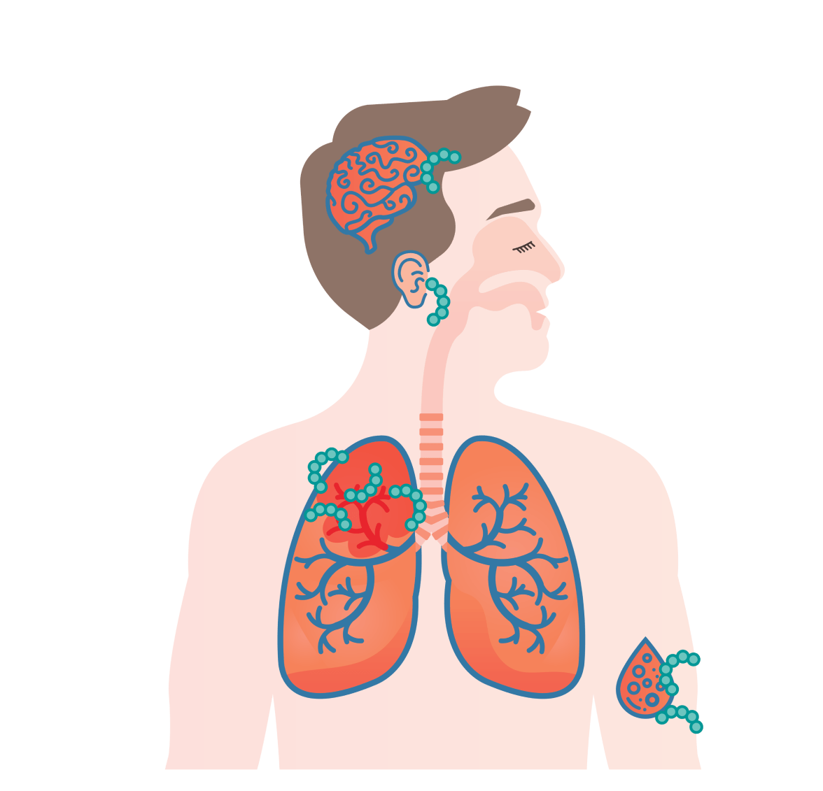 Wat is een pneumokokkenziekte? illustration