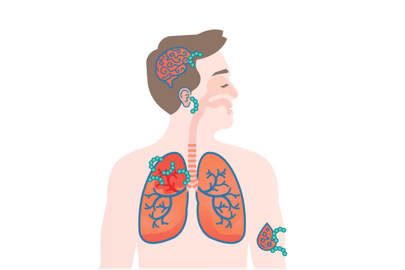 Wat is een pneumokokkenziekte?