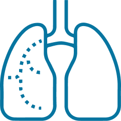 Pneumokokkenpneumonie pneumokokkenziekte